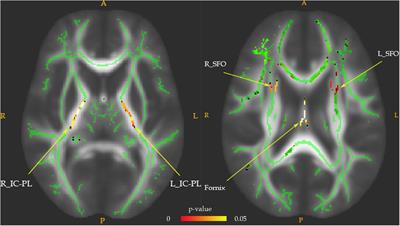 Correlation Between Serum High-Sensitivity C-Reactive Protein, Tumor Necrosis Factor-Alpha, Serum Interleukin-6 and White Matter Integrity Before and After the Treatment of Drug-Naïve Patients With Major Depressive Disorder